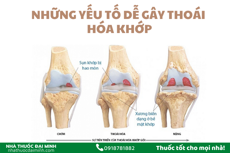 Thoái hóa khớp